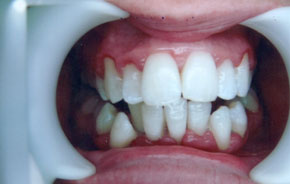 laser whitening at Dr. Sunil International Dental Clinic in Bangkok, Thailand